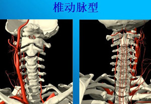 颈椎病引起的头晕