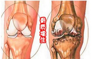 骨质增生的治疗