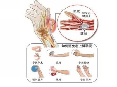 腱鞘炎症状表现