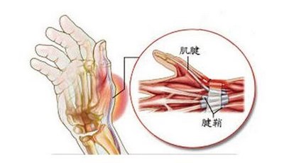 腱鞘炎症状