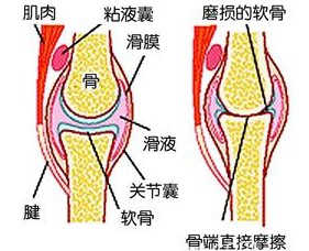 正常滑膜与病 变滑膜炎对比图