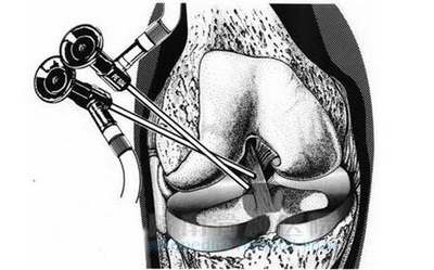 关节镜治疗膝关节炎